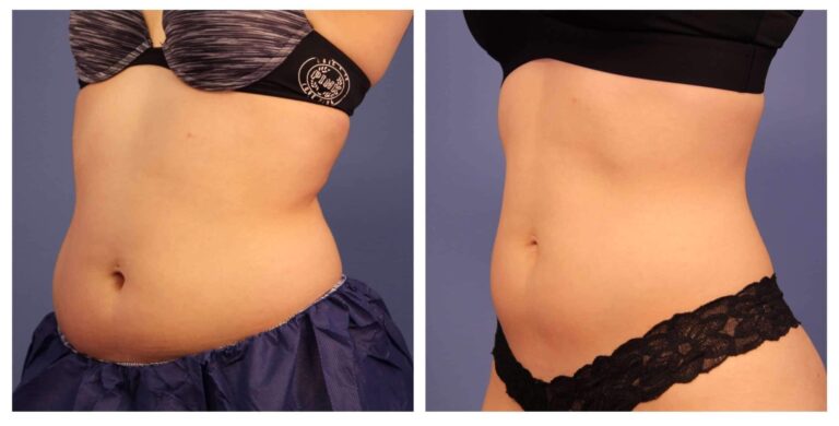 Coolsculpting: A Comprehensive Guide to Understanding the Procedure