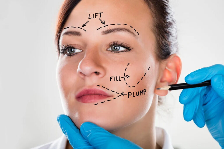 How long is the recovery time for Facelift Surgery?